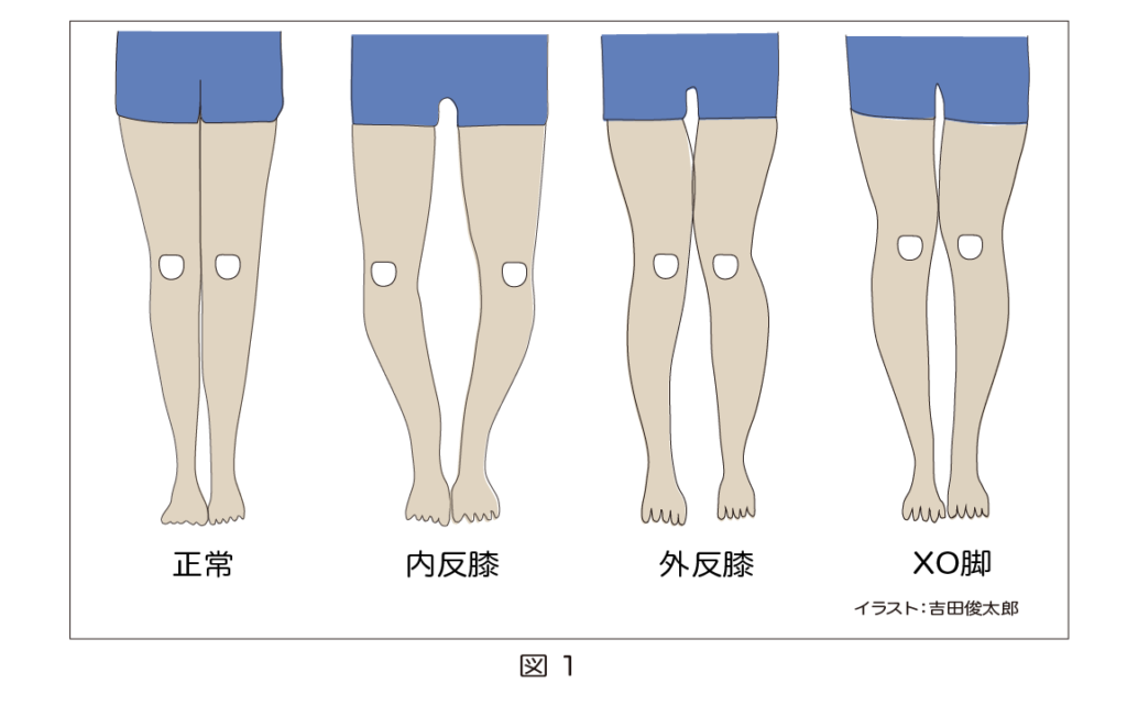 膝関節の異常アライメント
内反膝 
O脚
外反膝
X脚
XO脚
