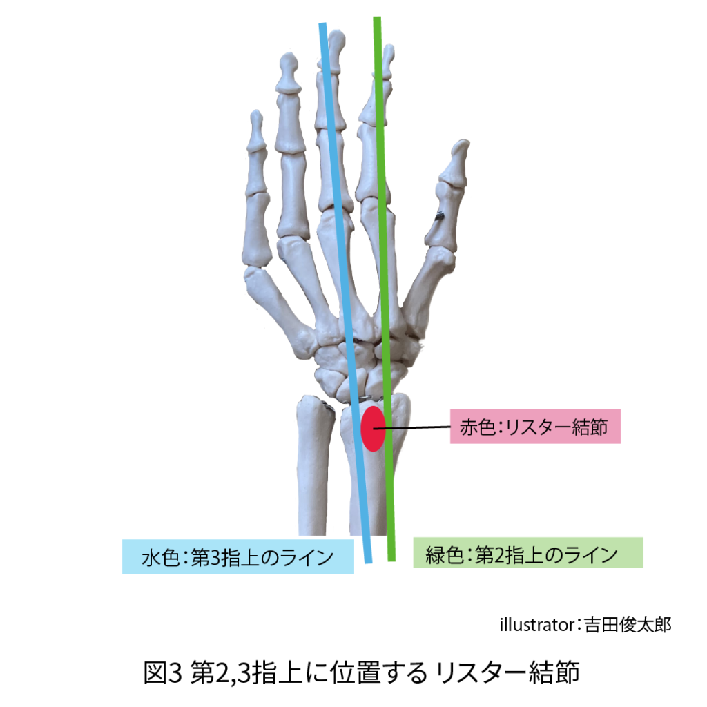第2,3指上に位置するリスター結節
リスター結節の触診方法