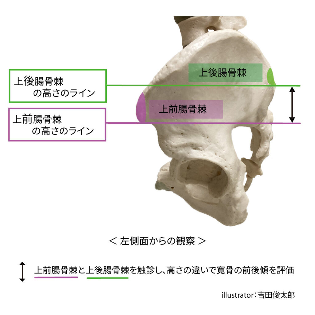 寛骨のアライメント評価時のランドマークとなる骨は上前腸骨棘と上後腸骨棘
一般的に両骨の間の高さの違いを元に、寛骨の前後傾の評価を実施します