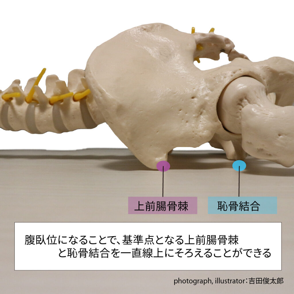 寛骨のバリエーションを考慮した際の寛骨のアライメント評価では、上前腸骨棘と恥骨結合を一直線上に並べる必要がある。そのためには腹臥位姿勢になることで、上前腸骨棘と恥骨結合を一直線上に揃えることができる